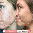 BeautyPro™ - High Frequency Wand